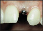 tand implantat