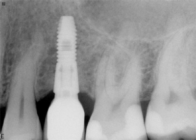tand implantat åkersberga